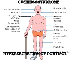 CUSHINGS SYNDROME  — AFFECTS ADRENAL CORTEX — HYPERSECRETION OF CORTISOL